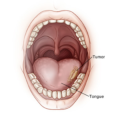 Tongue cancer treatment in KPHB